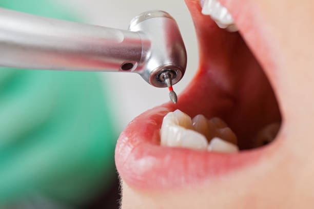 Best Lost Filling or Crown Replacement in Plainwell, MI